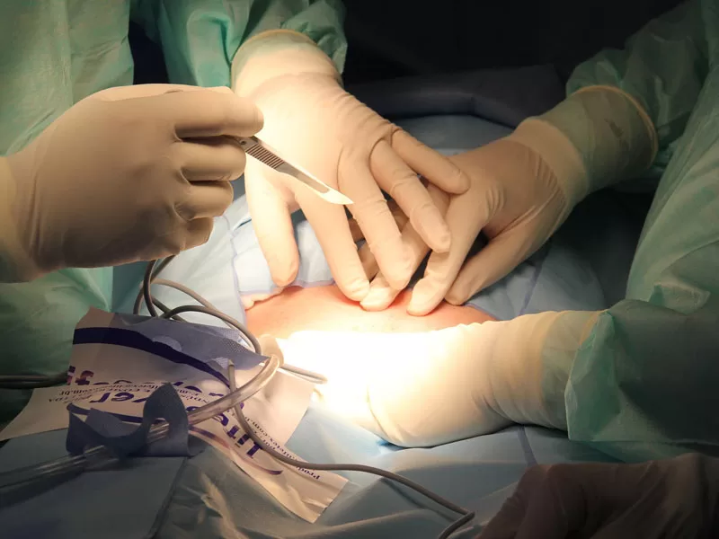 Surgical Intervention